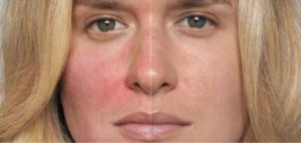 Do You Have Rosacea Botox Smart Skin Dermatology 0488