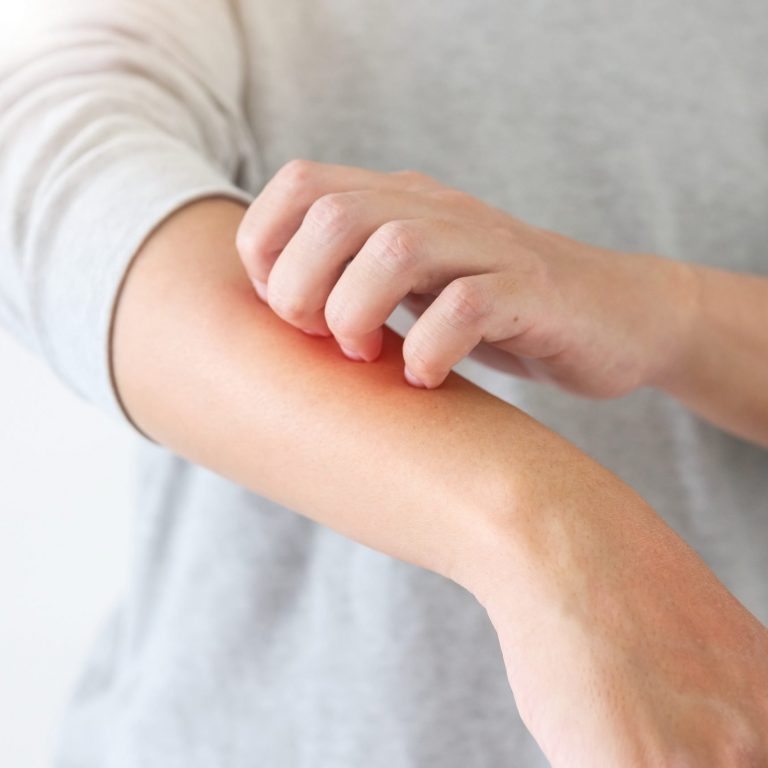 Atopic Dermatitis (Eczema) smart skin dermatology