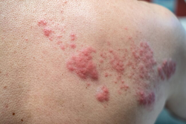 Shingles disease smart skin dermatology