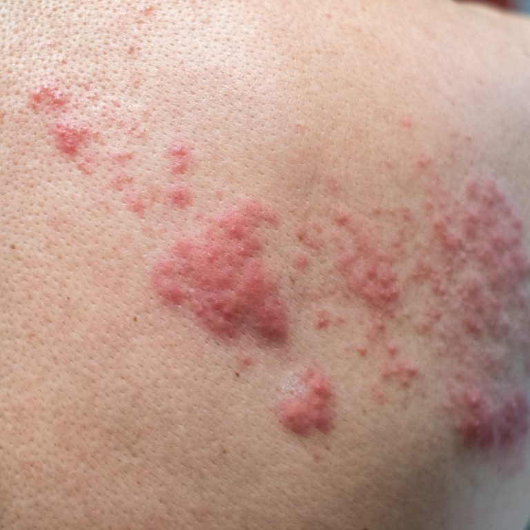 Shingles disease smart skin dermatology