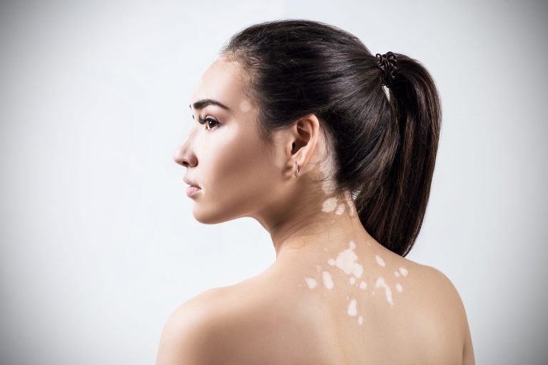 vitiligo smart skin dermatology