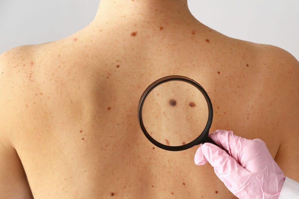 Melanoma skin cancer