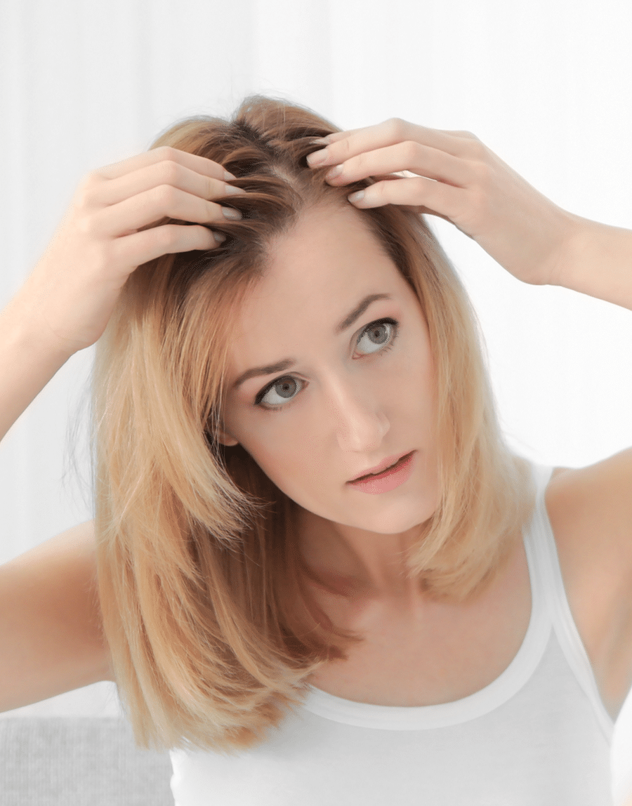 alopecia hair loss