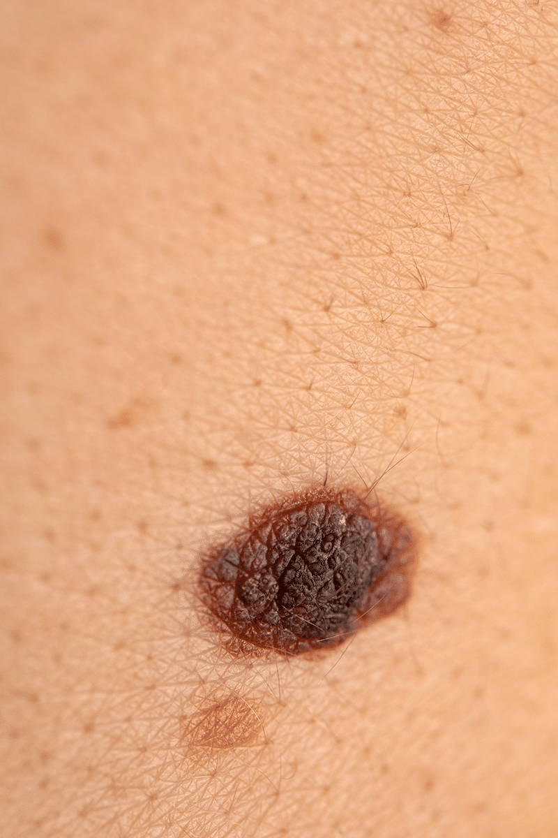 preventing melanoma skin cancer in utah
