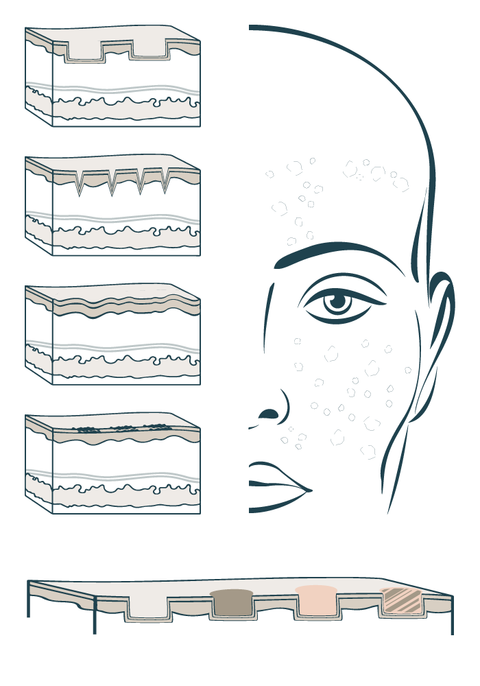 Types of acne scarring