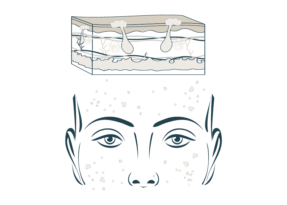 Aviclear laser acne treatment