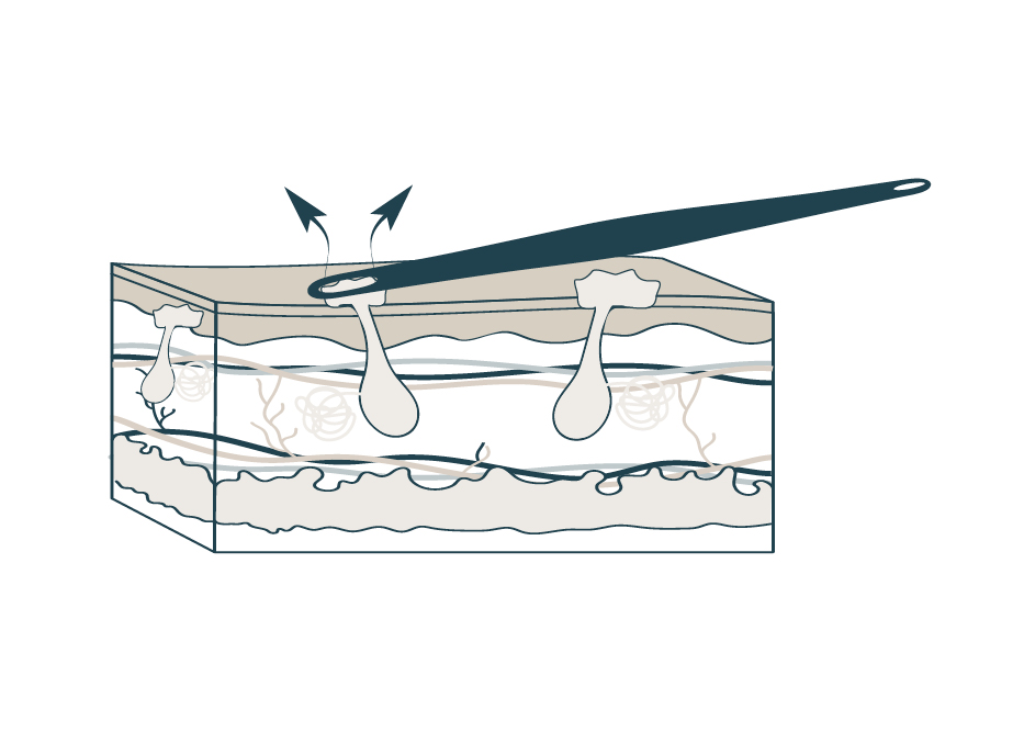 acne extractions