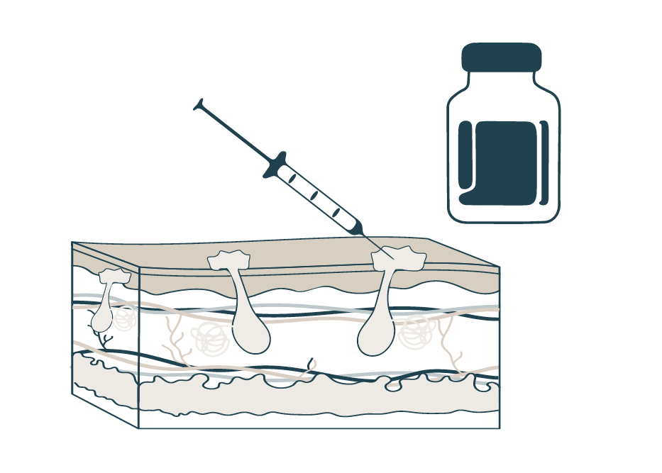 steroid injections for acne