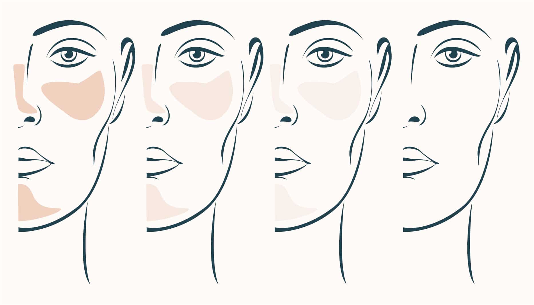 how rosacea fades with vbeam laser