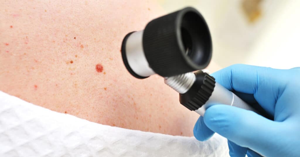 Skin Cancer Screening
