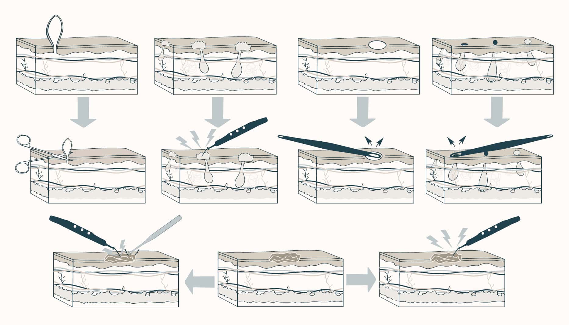 skin tag removal, electrocautery and extractions