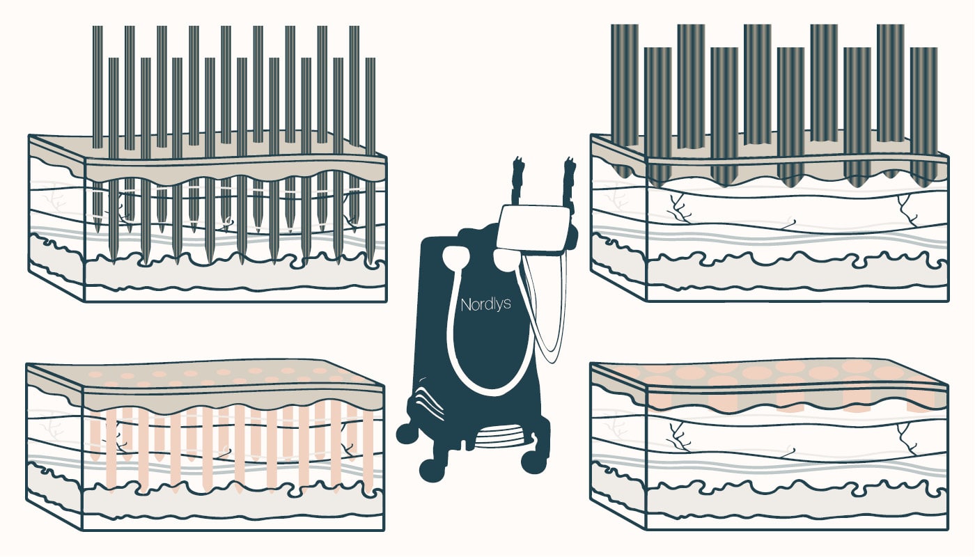 1550 and 1940 laser wavelengths frax laser