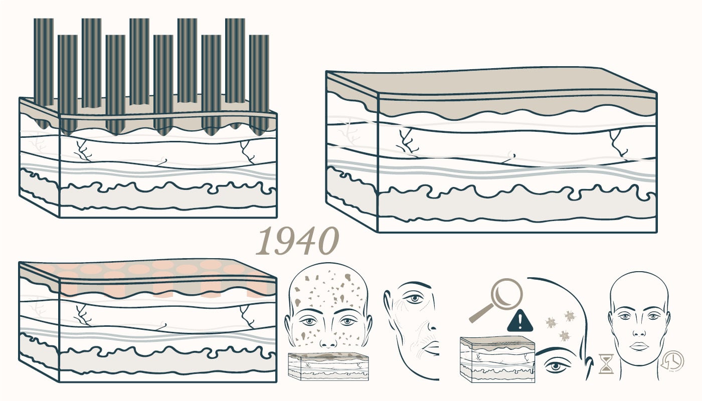 1940 frax laser results