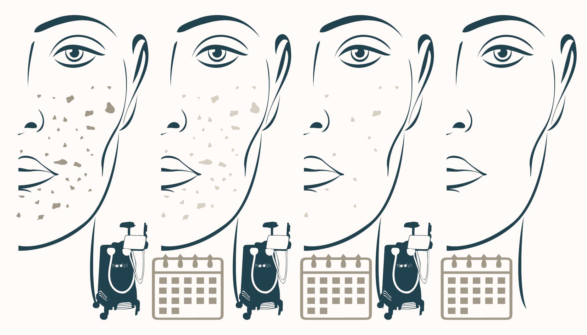 brown pigment lightening from IPL