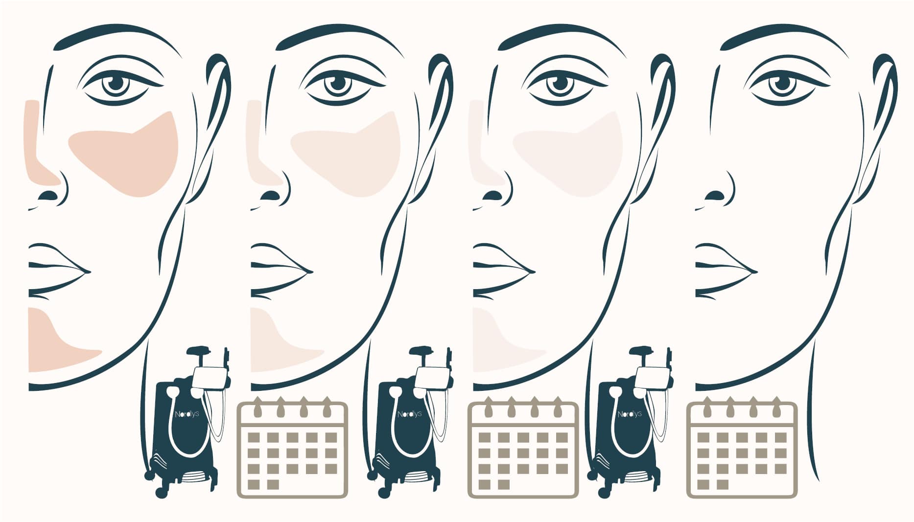 blood vessel improvement following IPL treatment