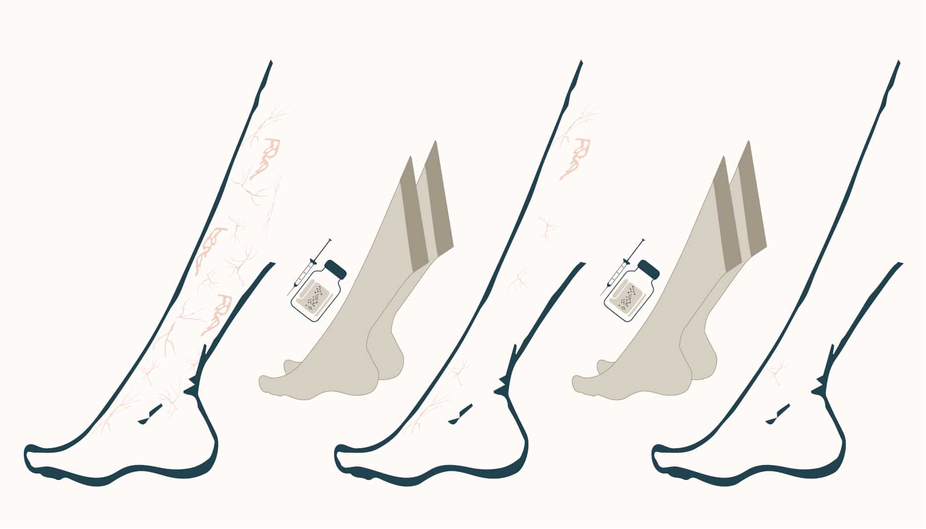 sclerotherapy expected results