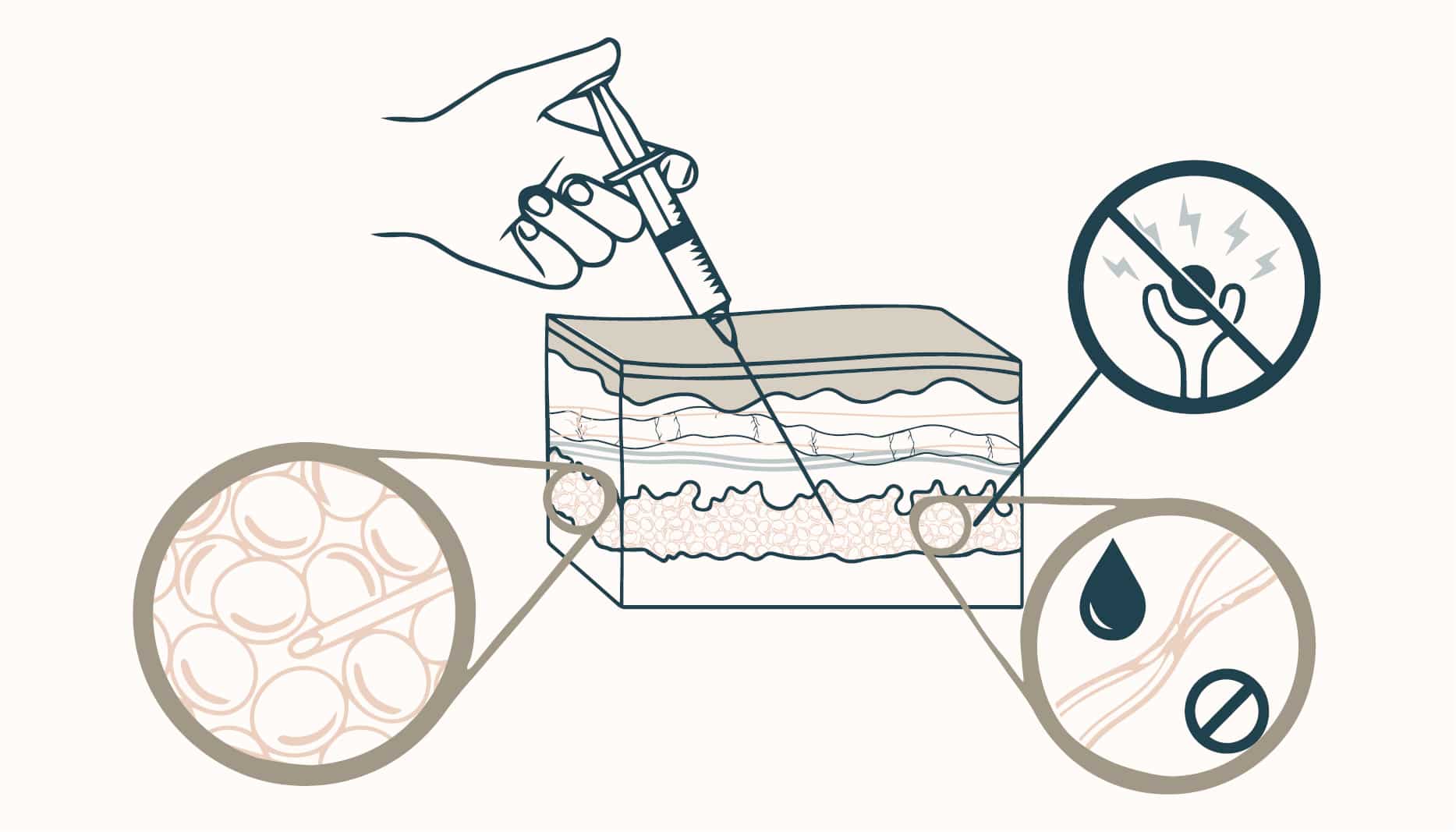 diagram showing how tumescence infiltration works