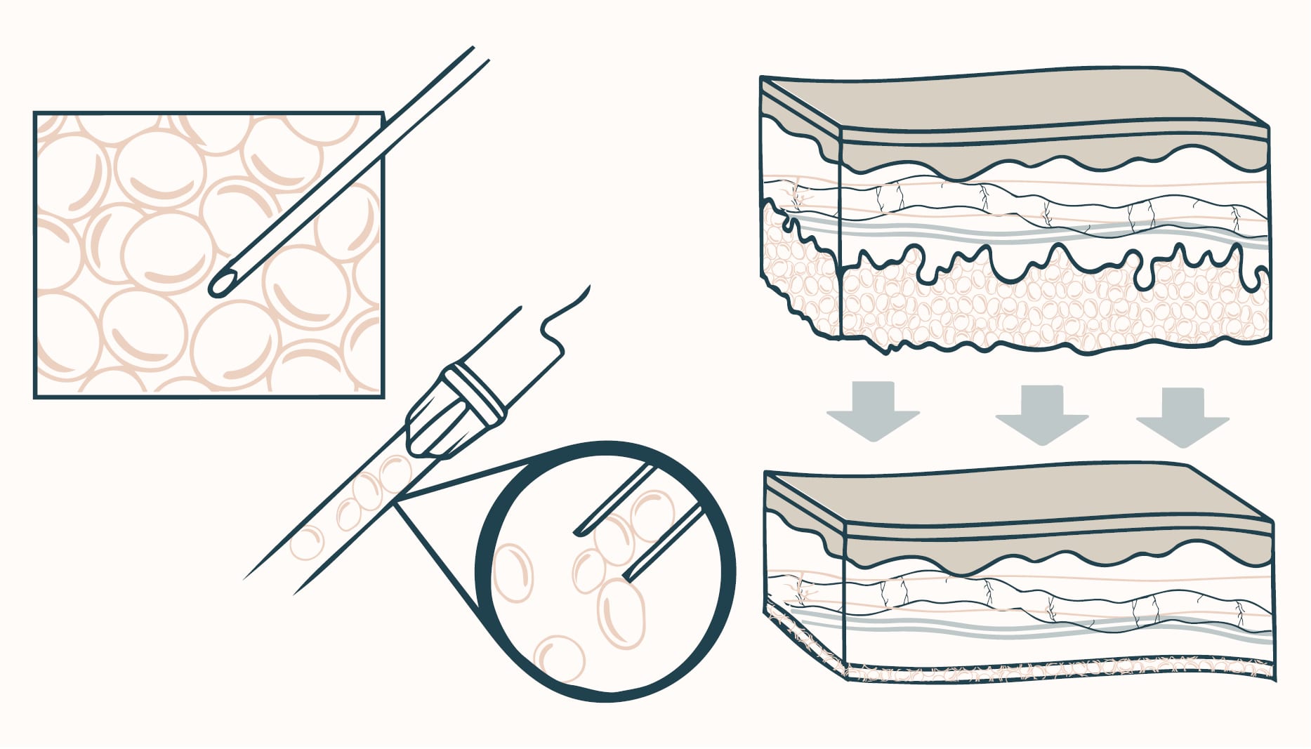 diagram of how liposuction aspiration works