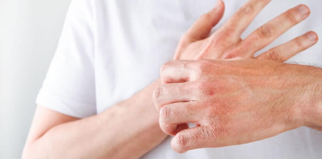 eczema on hands of male