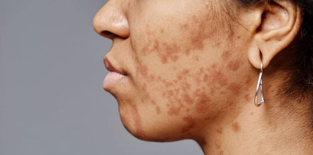 Melasma on cheeks of woman with visible facial hyperpigmentation