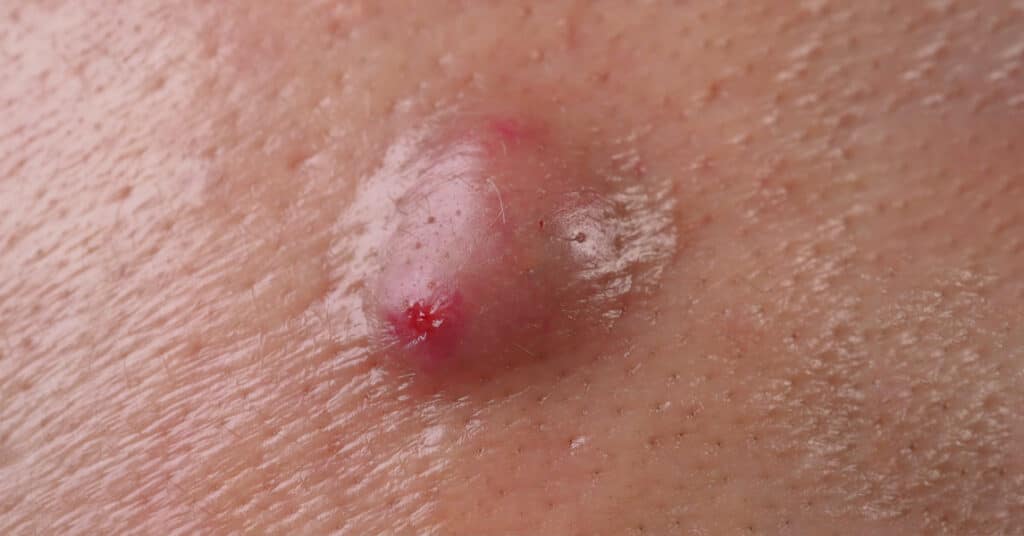 Inflamed acne cyst on face