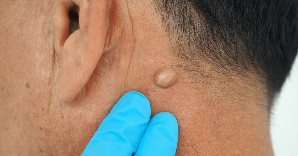 cyst on man's neck before being removed by dermatologist