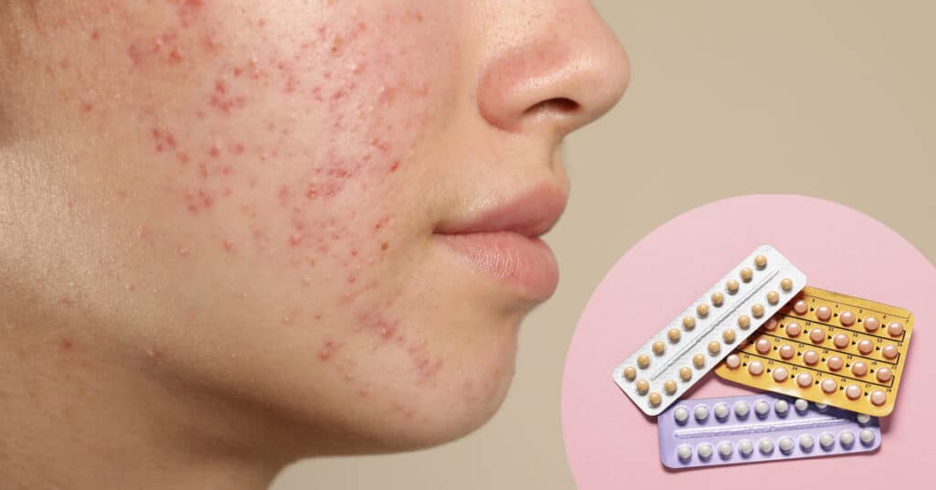 Woman with acne concerned about birth control causing acne breakouts