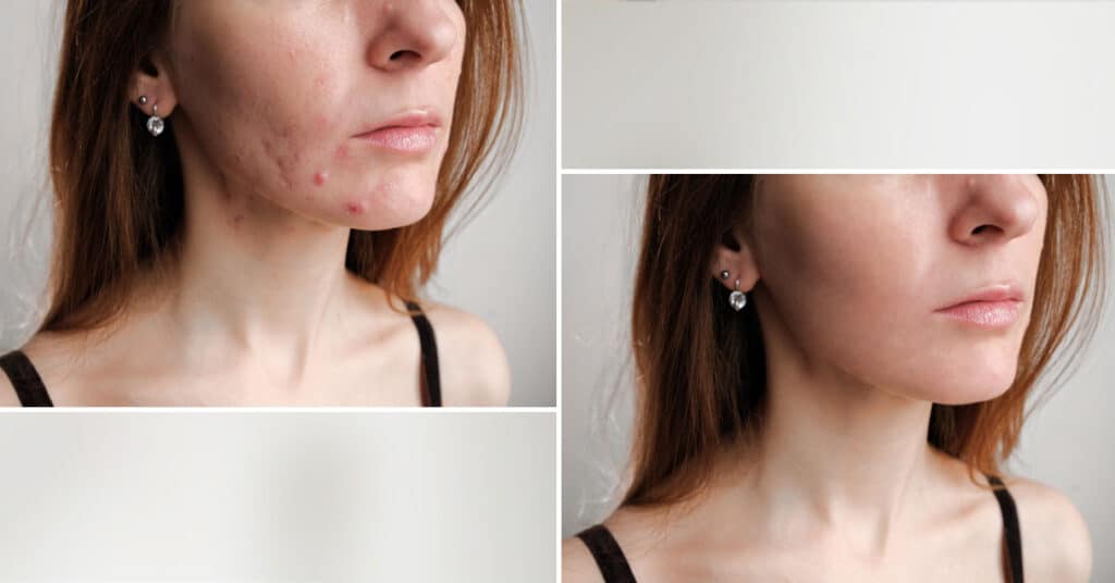 Accutane long term results