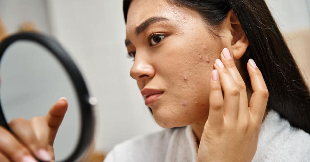 young woman concerned about facial acne after starting accutane