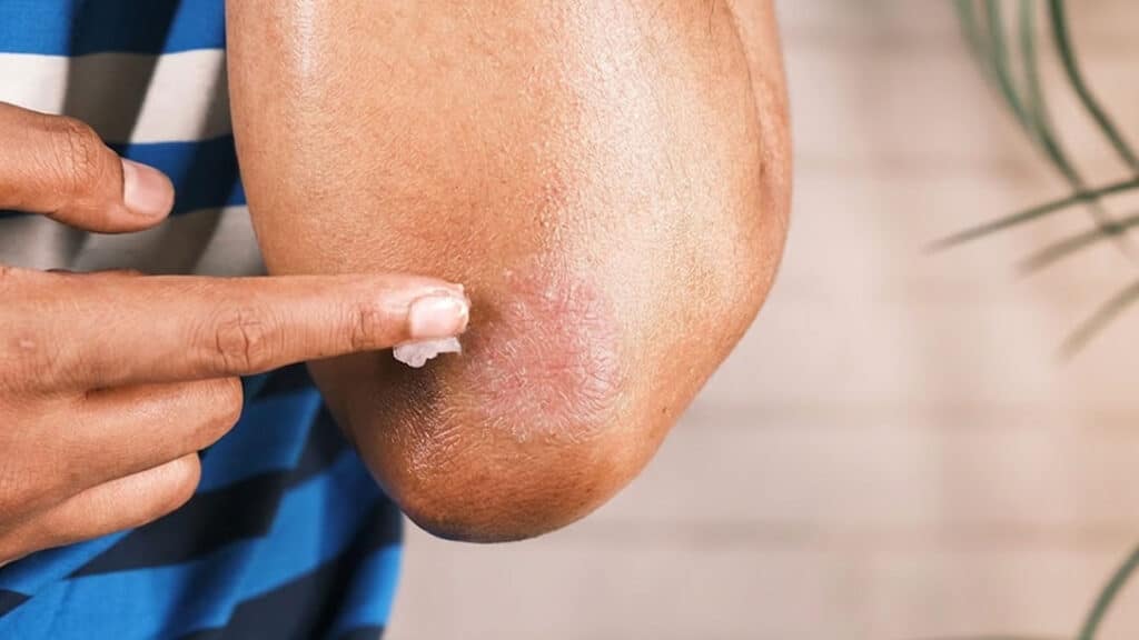 Man applying cream to his elbow to treat his psoriasis