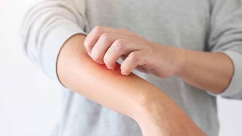 Man applying steroid cream safely to treat eczema on his arm
