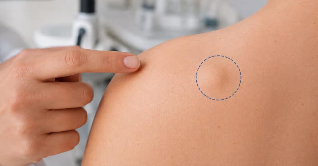 Dermatologist checking lipoma on man's upper back