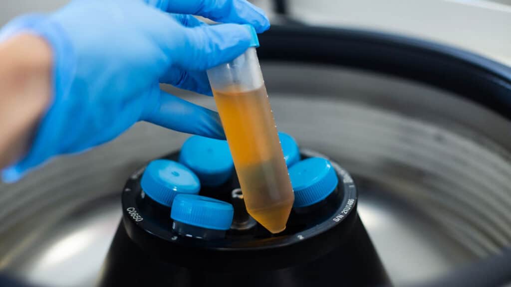PRP blood sample being processed in a centrifuge for comparison with exosome treatment