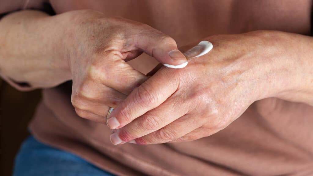 Person applying prescription steroid cream to an eczema rash on the hand