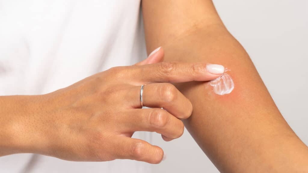Person treating contact dermatitis at home with cream