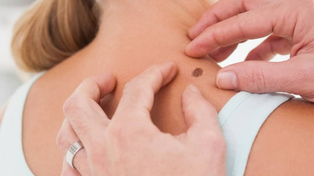 Dermatologist examining a mole on a patient's shoulder
