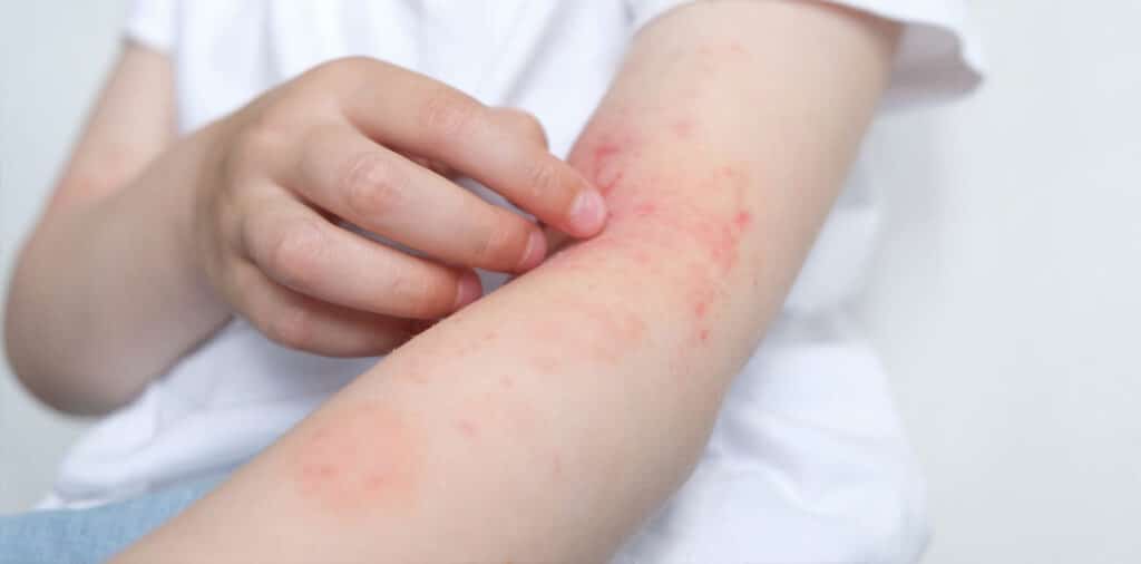 Person scratching red, irritated skin on their forearm caused by eczema.