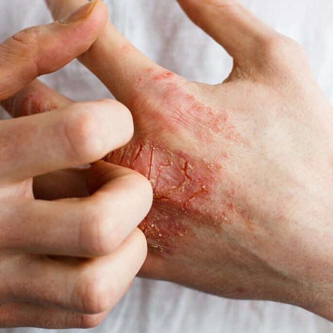 The problem with many people - eczema on hand.