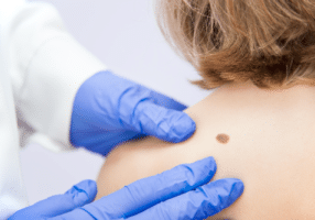 dermatology mole check