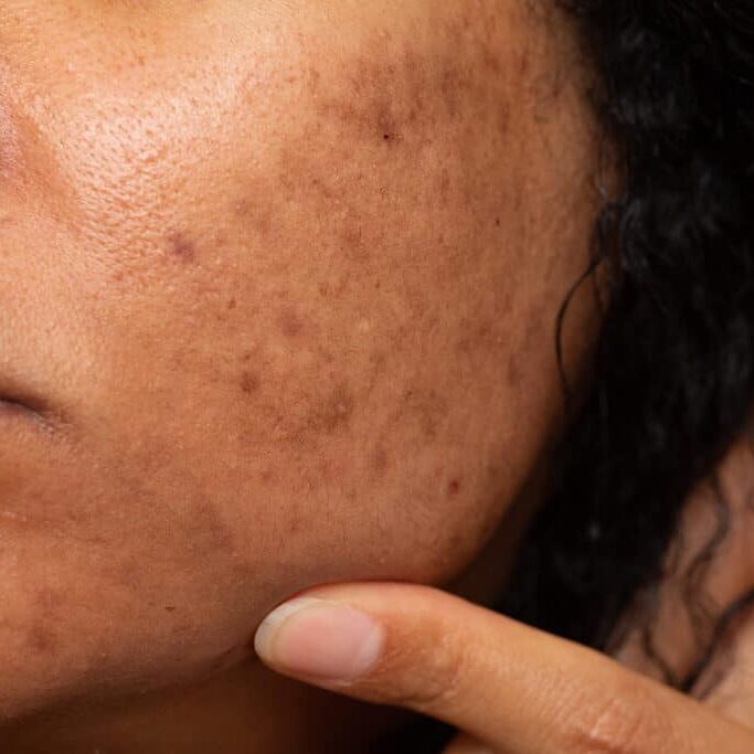 Closeup of Asian woman with dark spots and freckles problems. High quality photo