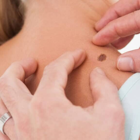 Dermatologist examining a mole on a patient's shoulder